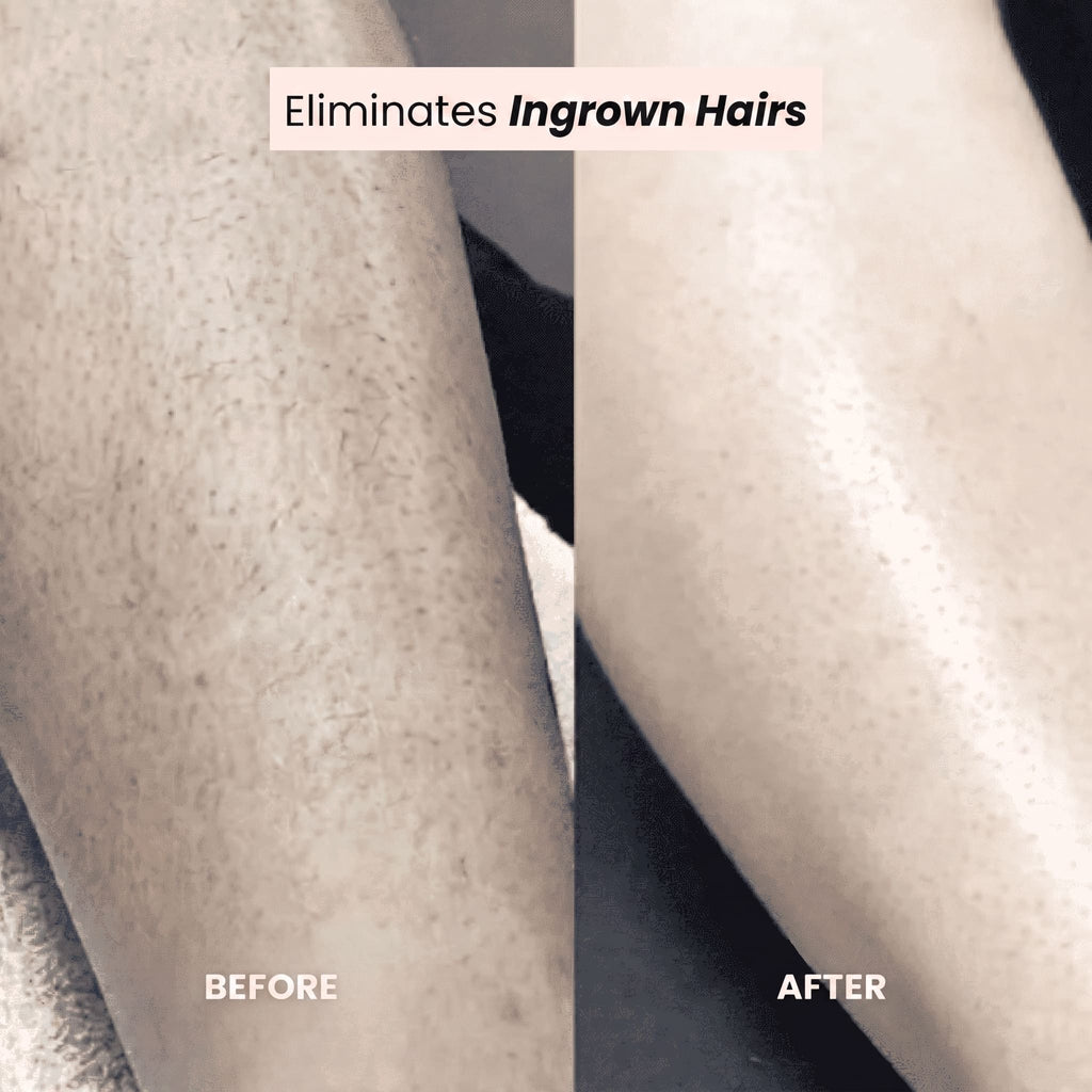 FreshSkin - Ingrown Hair Razor