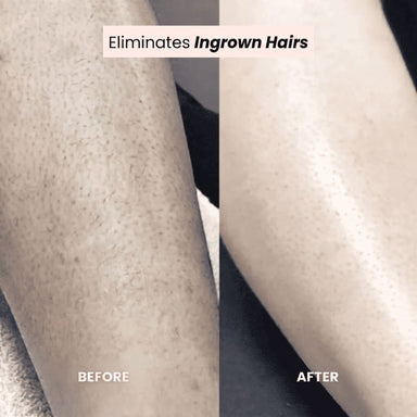 FreshSkin - Ingrown Hair Razor
