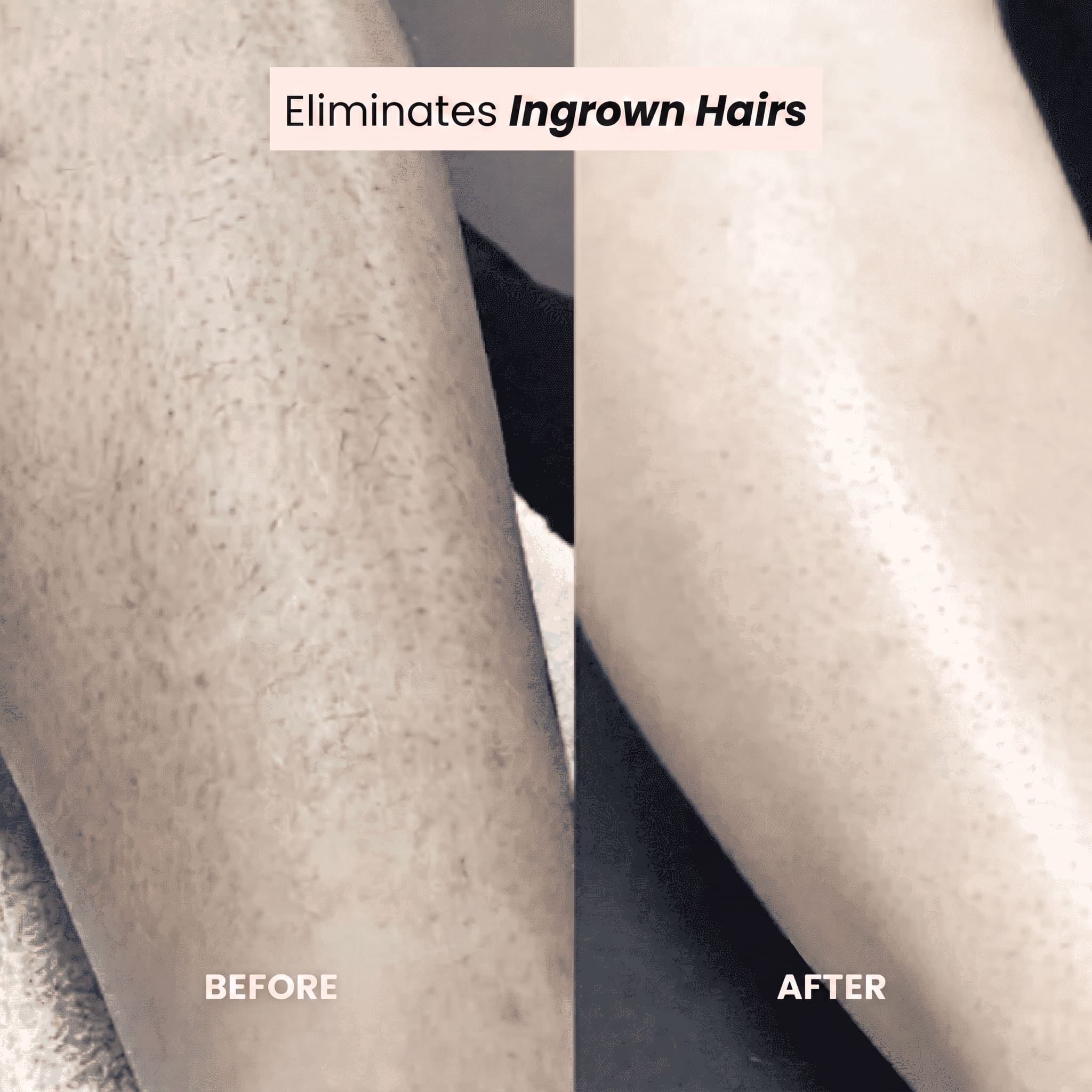 FreshSkin - Ingrown Hair Razor