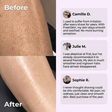 FreshSkin - Ingrown Hair Razor