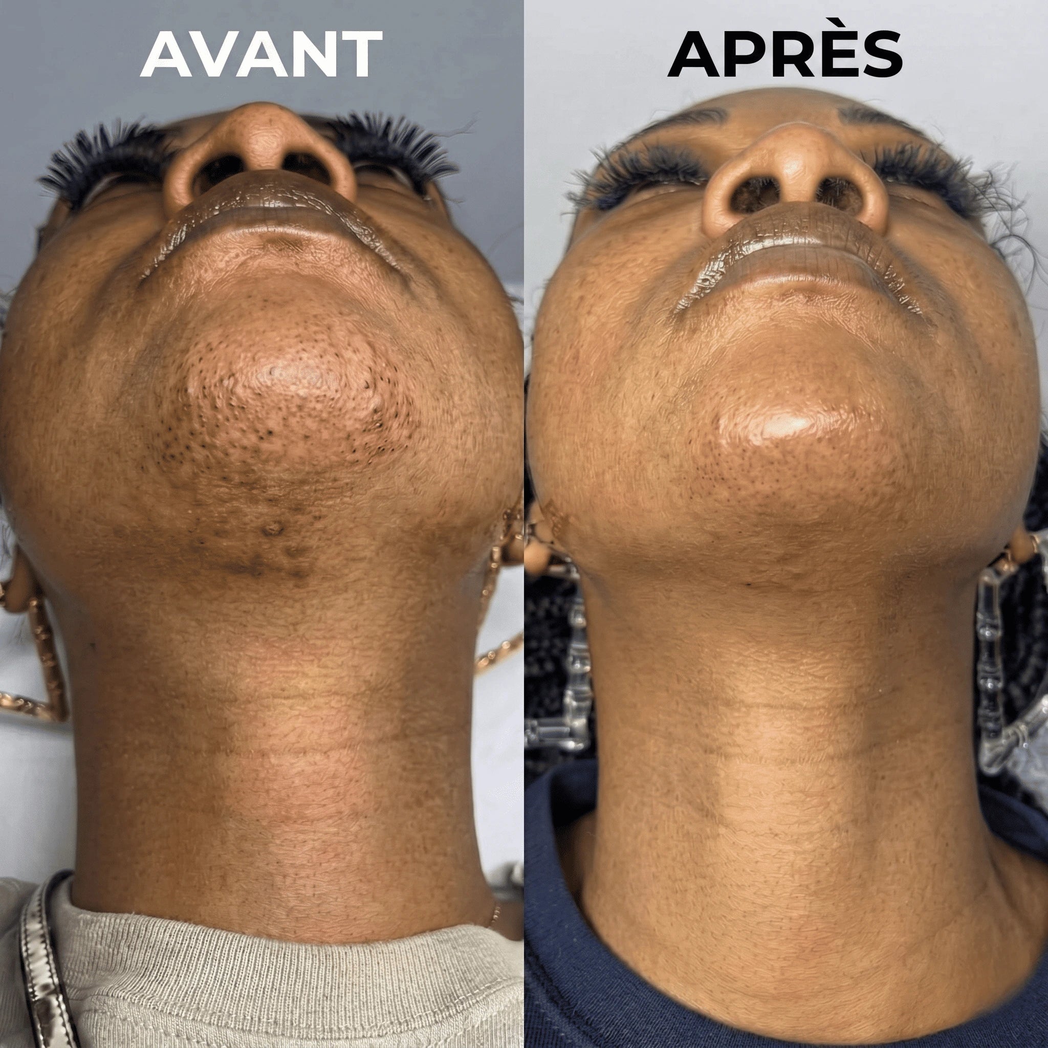 PureSkin - Sérum lissant anti-repousse de poils